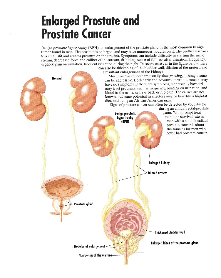 a prosztatitis gyógynövényekkel való kezelése